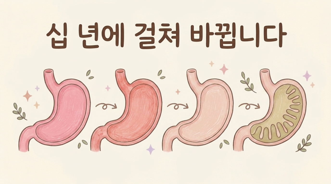 정상 위 점막에서 만성 위염, 위축성 위염, 장상피화생으로 이어지는 진행 과정 일러스트