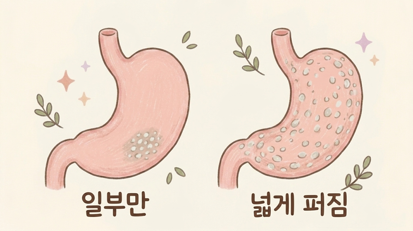 위 일부에만 있는 경우와 위 전체에 넓게 퍼진 경우를 비교한 일러스트